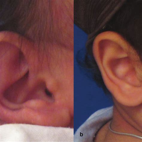 Pdf Non Surgical Management Of Congenital Auricular Deformities