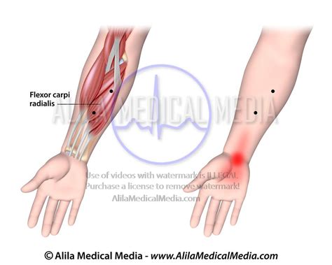 Alila Medical Media Trigger Points And Referred Pain For The Flexor Carpi Radialis Medical