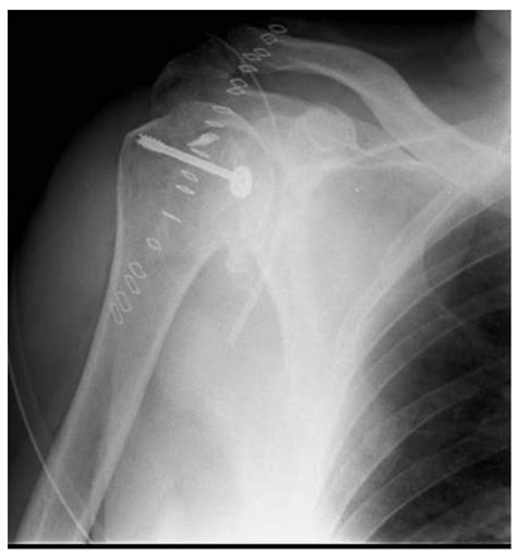 Jcm Free Full Text Posterior Shoulder Dislocation With Engaging