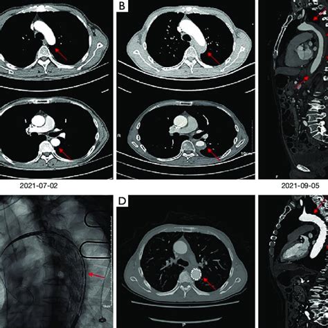 Chest Ct Before And After Fruquintinib Treatment A Aortic Dissection