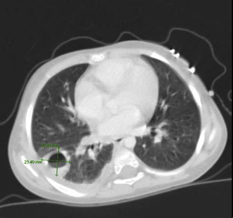 Ct Scan Of The Chest Abscess Formation In The Right Lower Lobe