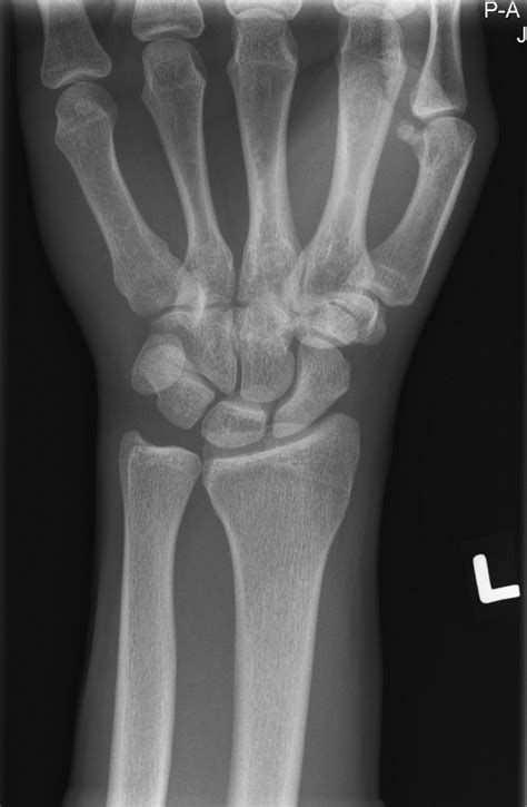 Wrist Injury Image