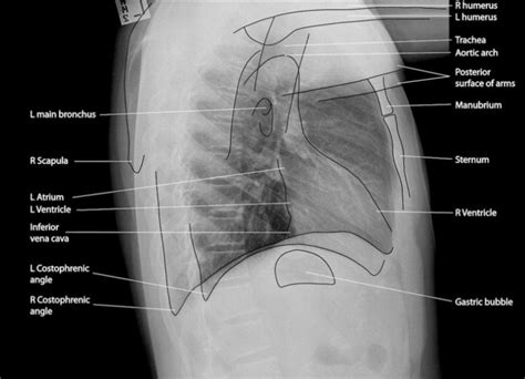 The cause of dextrocardia is unknown. Normal, Labelled, Chest x-ray - Undergraduate Diagnostic ...