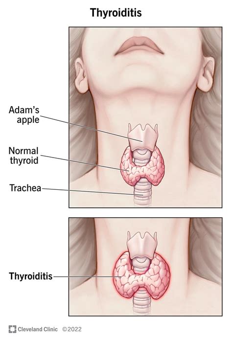What Is Thyroiditis Types Symptoms Treatment Patient Guide The Best