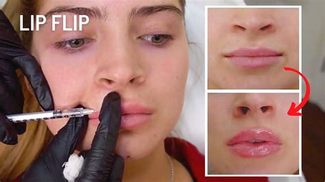 Lip Flip Botox Before And After Photos