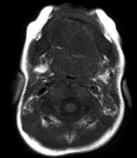 Imaging Of 2 Month Old Female Patient With Sublingual Dermoid Cyst In