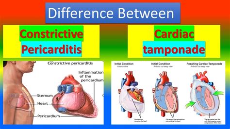 Difference Between Constrictive Pericarditis And Cardiac Tamponade
