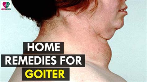 Home Remedies For Goiter Health Sutra Youtube
