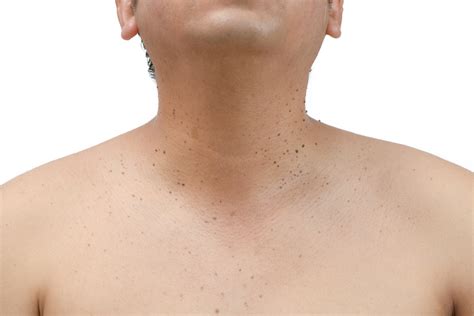 Skin Tag Removal Integrity Paramedical Skin Practitioners