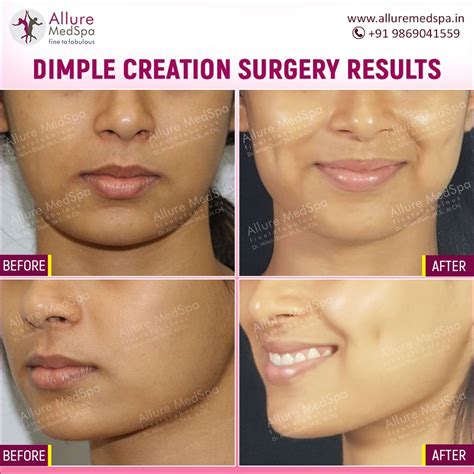 Dimpleplasty Dimple Surgery Dimples Surgery