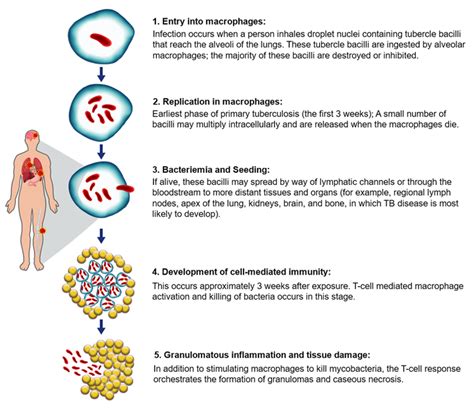 Pathogenesis Of TB Knowledge Base