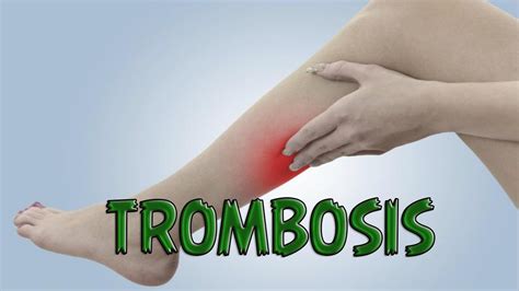 La flebotrombosis y la tromboflebitis. Trombosis - Cuitan Dokter