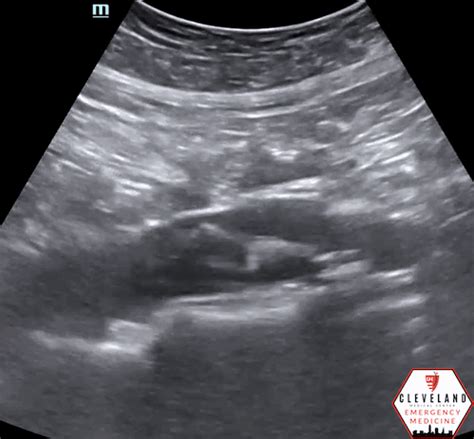 Intern Ultrasound Of The Month Aortic Dissection — University