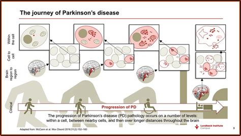 Phases Of Parkinsons Disease
