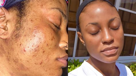 Hyperpigmentation Causes Home Remedies And Medical Treatments Justinboey