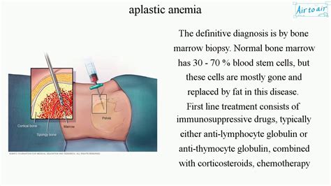 Aplastic Anemia English Medical Terminology For Medical Students