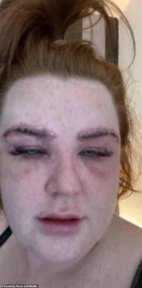 Womans Eyebrows Fell Off After Allergic Reaction To A Wax And Tint