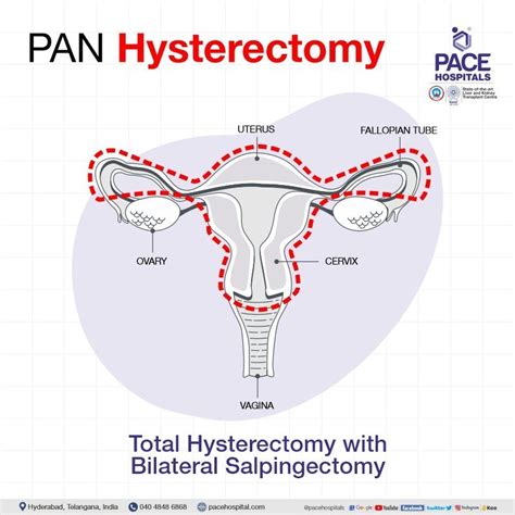 Hysterectomy Surgery In Hyderabad Indications Side Effects Cost