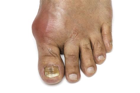 Gout Signs Symptoms And Complications