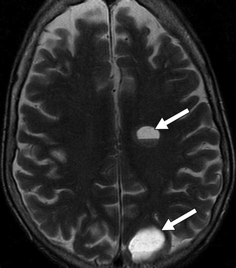 Merkel Cell Carcinoma A Primer For The Radiologist Ajr