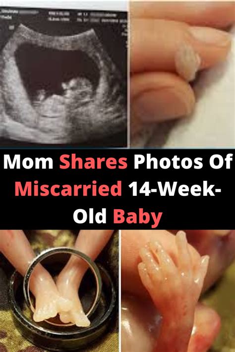 What Does A Miscarriage Look Like At 4 Weeks