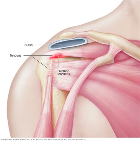 Tendinitis Middlesex Health