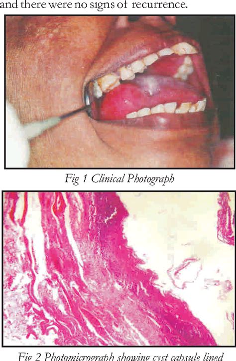 Figure 1 From Unusual Presentation Of Epidermoid Cyst Of The Oral