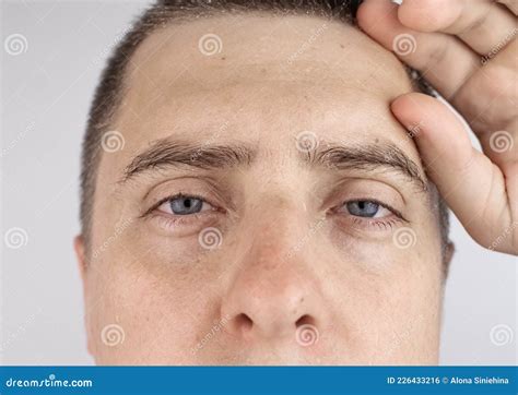 A Man With Sweating On His Face Is Looking At The Camera Sweat Gland