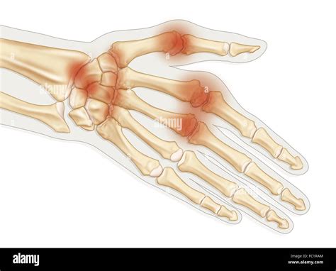 Rheumatoid Arthritis Hands Hi Res Stock Photography And Images Alamy