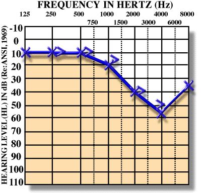You can see that the pitch or this is how an interpretation of an audiogram is made. Sensorineural hearing loss