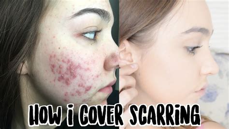 Full Coverage Foundation Routine For Acne Scarring Hyperpigmentation