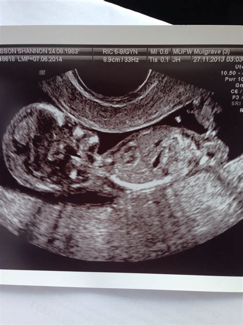 13 Week Ultrasound Boy Or Girl
