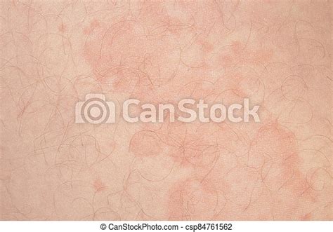 Skin Disease Urticariaskin Red Spots And Itching Canstock