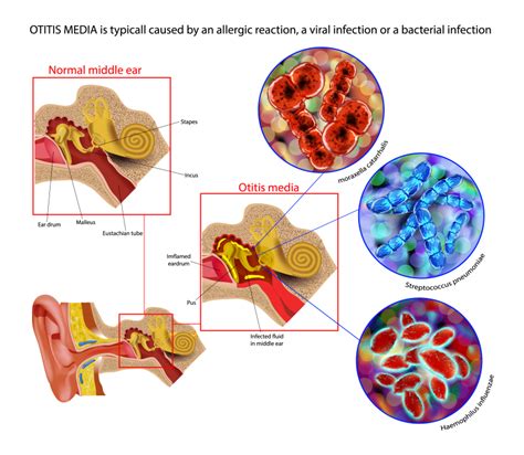 Figure Acute Otitis Media Statpearls Ncbi Bookshelf