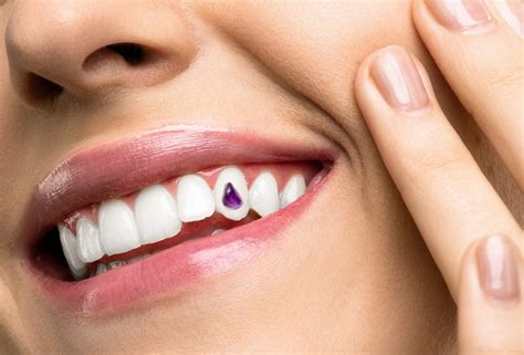 Everything You Need To Know About Tooth Gemstones