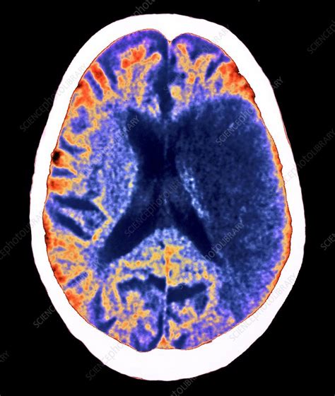 Stroke Ct Brain Scan Stock Image M1360345 Science Photo Library