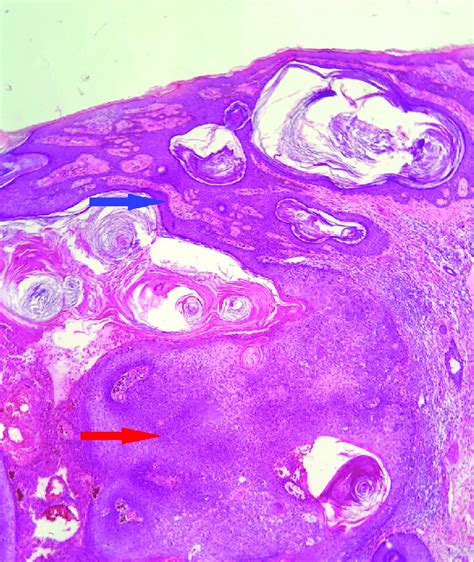 Histopathology Shows At The Top Of The Image Proliferation Of