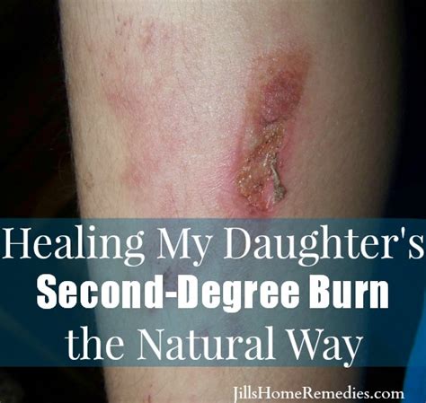 Healing My Daughters Second Degree Burn Jills Home Remedies