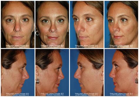 Asymmetrical Nose Before And After Photo Gallery Nose Surgery Photos
