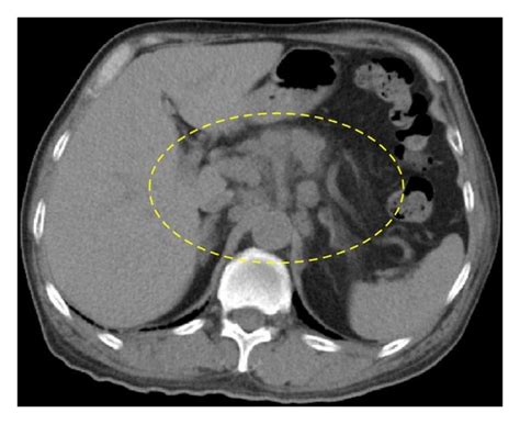 A Abdominal Ct Showing Enlarged Para Aortic Lymph Nodes B After