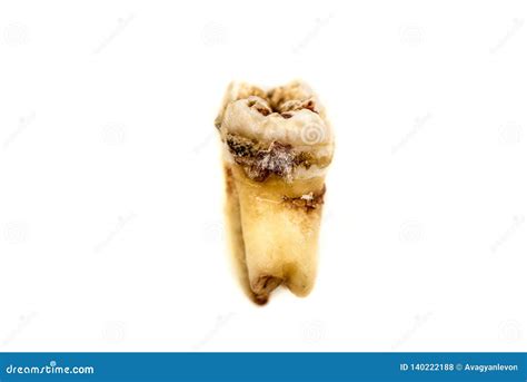 Decayed Wisdom Tooth Stock Photo Image Of Decay Pull 140222188