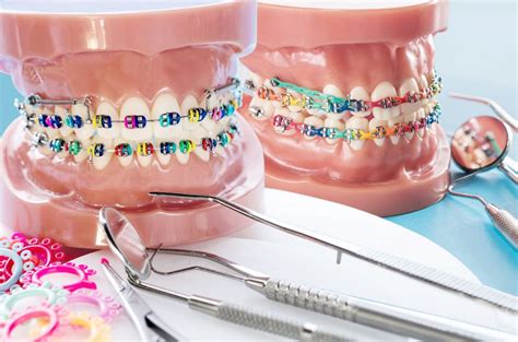How Much Do Braces Cost Without Insurance Insurance Noon