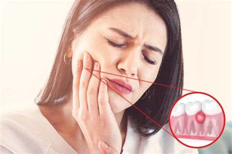 What Are Dental Abscesses Miami Fl Gallardo Periodontics