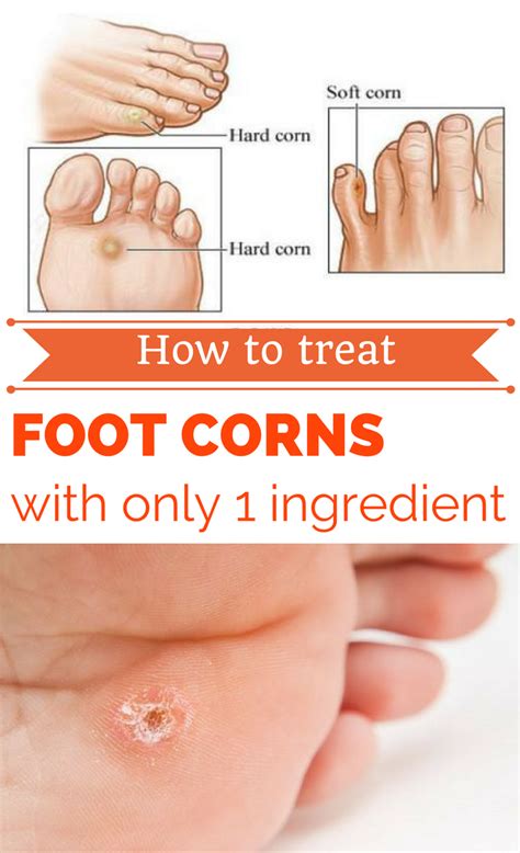 How To Treat Foot Corns With Only 1 Ingredient Get Rid Of Corns Get