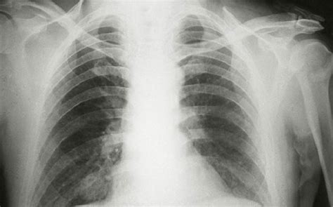 # việt quang qua đời vì viêm phổi. Viêm phổi virus RSV, Adenovirus là gì? Cách chữa nhanh ...