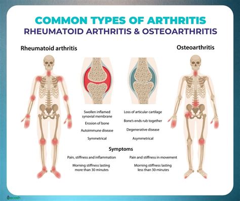 Understanding Osteoarthritis Causes Symptoms And Treatment Health News Website