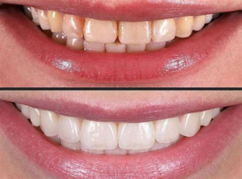 smile enhancement with porcelain veneers stunning dentistry blog