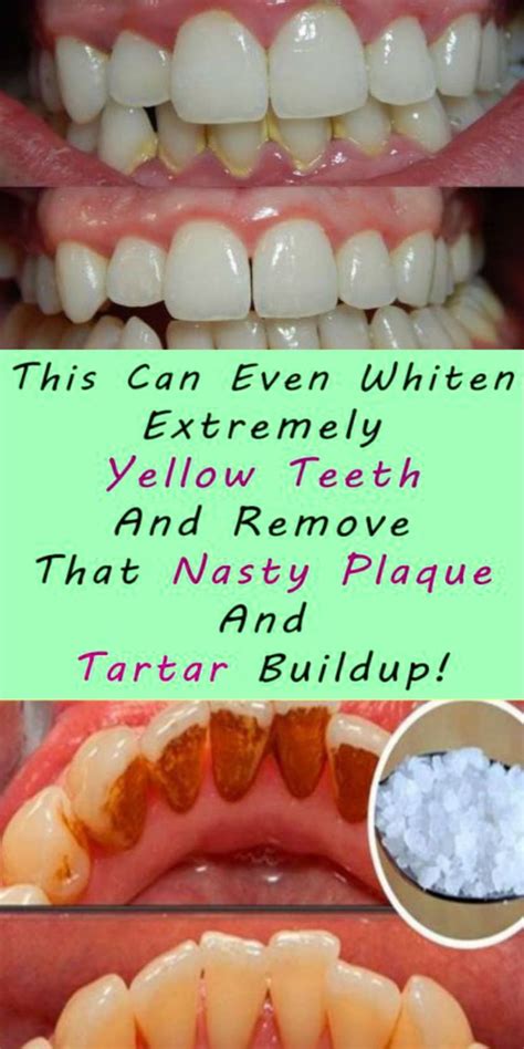 How To Get Rid Of Calcium Buildup On Teeth