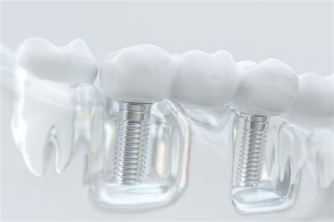 An Implant Dentist Discusses 5 Cosmetic Benefits Of Replacing Missing