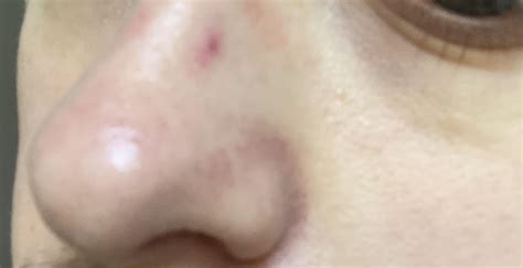 Red Mark On Nose Its Been There For A Long Time Wont Go Away